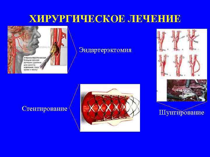 ХИРУРГИЧЕСКОЕ ЛЕЧЕНИЕ Эндартерэктомия Стентирование Шунтирование 