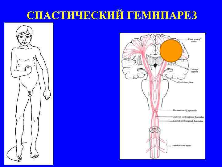 СПАСТИЧЕСКИЙ ГЕМИПАРЕЗ 