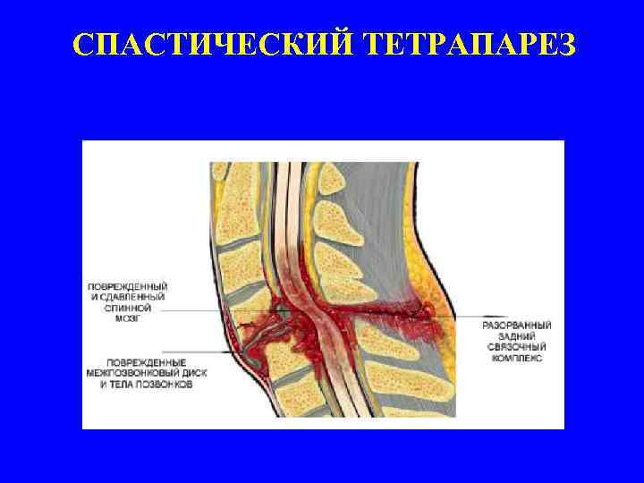СПАСТИЧЕСКИЙ ТЕТРАПАРЕЗ 