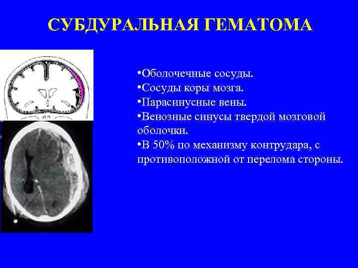 СУБДУРАЛЬНАЯ ГЕМАТОМА • Оболочечные сосуды. • Сосуды коры мозга. • Парасинусные вены. • Венозные