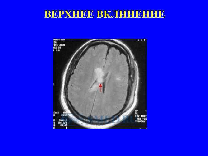 ВЕРХНЕЕ ВКЛИНЕНИЕ 