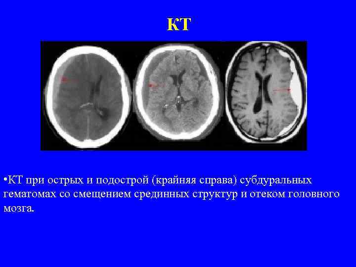 КТ • КТ при острых и подострой (крайняя справа) субдуральных гематомах со смещением срединных