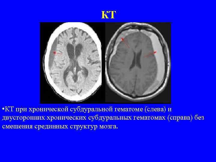 КТ • КТ при хронической субдуральной гематоме (слева) и двусторонних хронических субдуральных гематомах (справа)