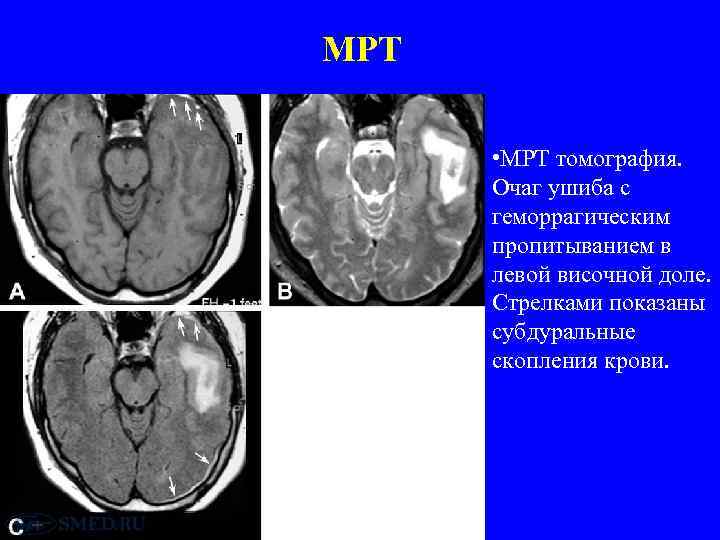 МРТ • МРТ томография. Очаг ушиба с геморрагическим пропитыванием в левой височной доле. Стрелками