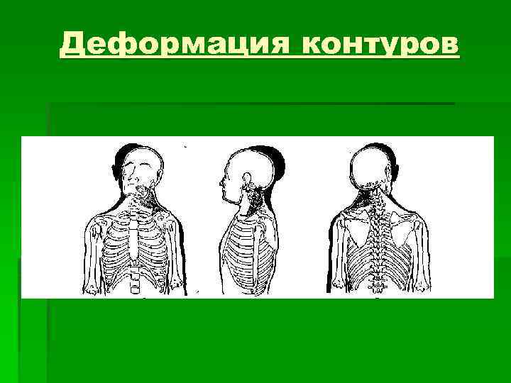 Деформация контуров 