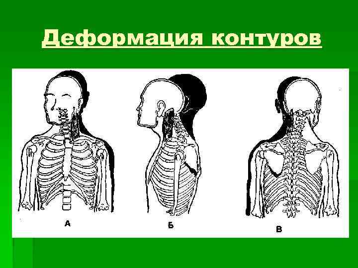 Деформация контуров 