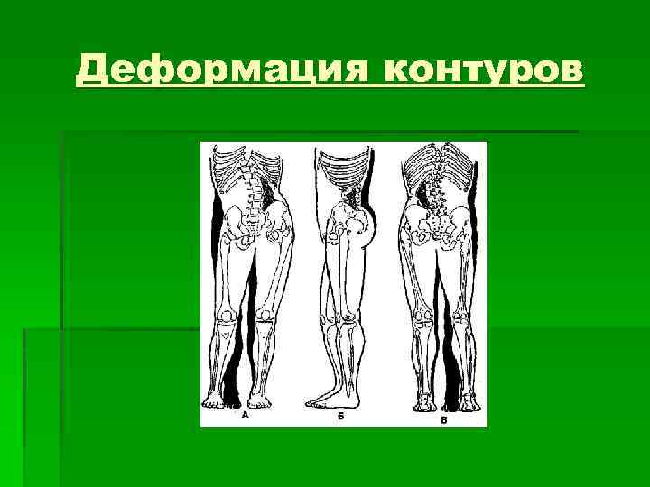 Деформация контуров 