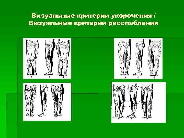 Визуальные критерии укорочения / Визуальные критерии расслабления 