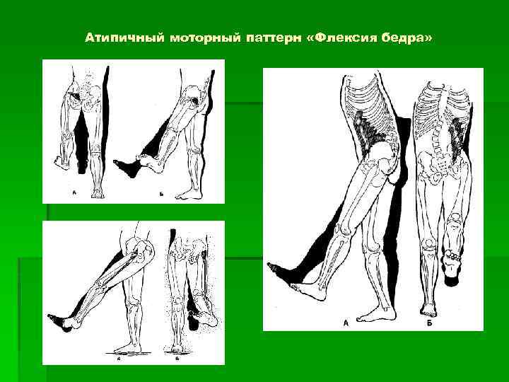 Атипичный моторный паттерн «Флексия бедра» 