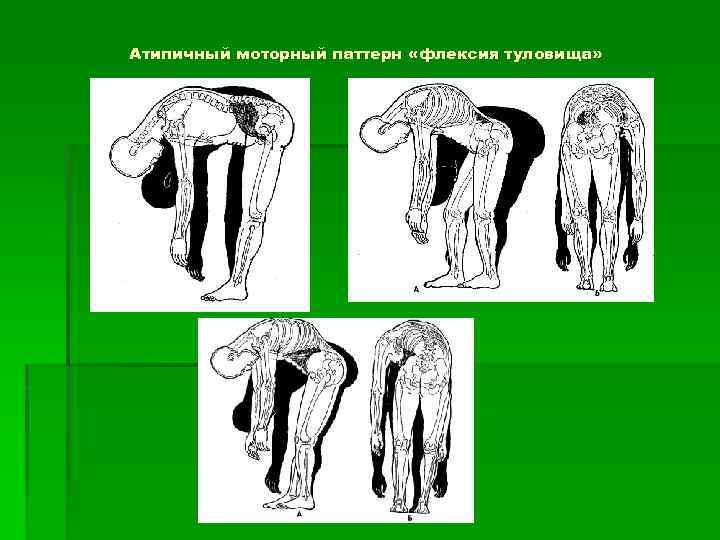 Атипичный моторный паттерн «флексия туловища» 