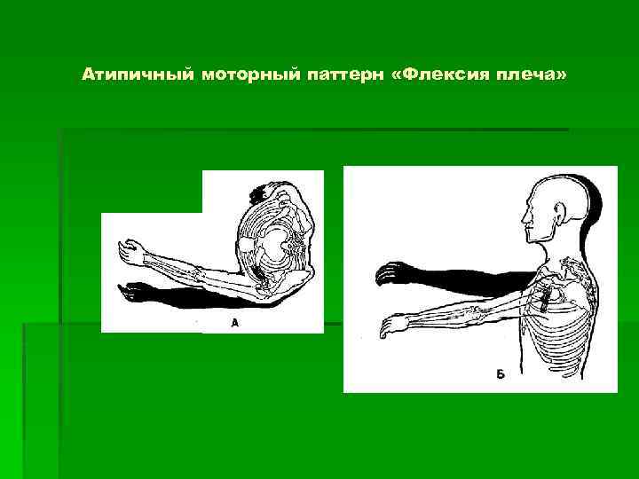 Атипичный моторный паттерн «Флексия плеча» 