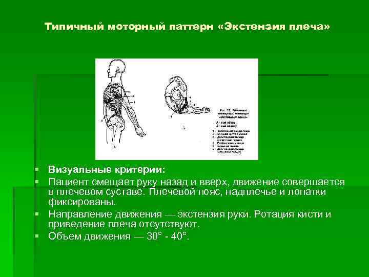 Типичный моторный паттерн «Экстензия плеча» § Визуальные критерии: § Пациент смещает руку назад и