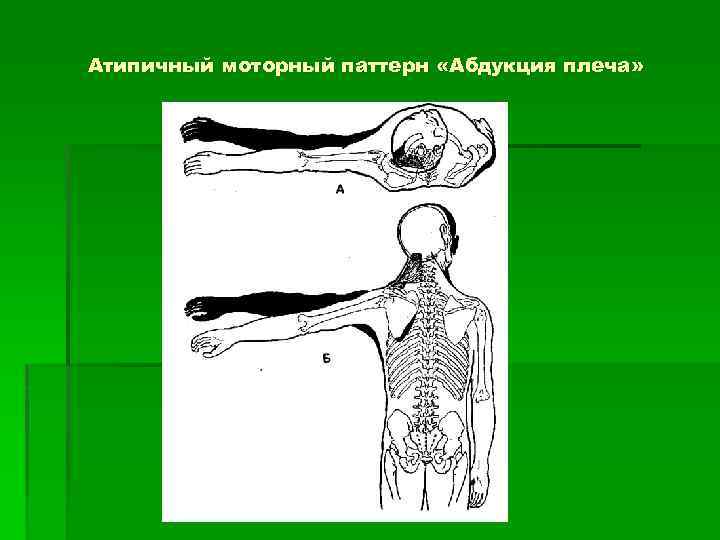 Атипичный моторный паттерн «Абдукция плеча» 