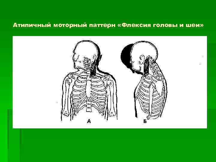 Атипичный моторный паттерн «Флексия головы и шеи» 