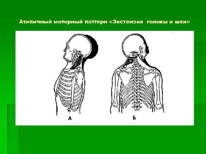 Атипичный моторный паттерн «Экстензия головы и шеи» 