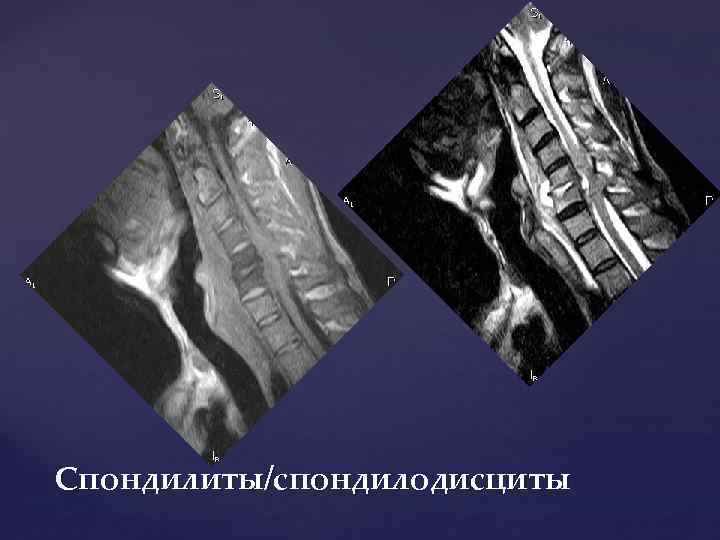 Спондилиты/спондилодисциты 