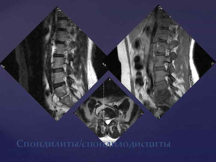 Спондилиты/спондилодисциты 