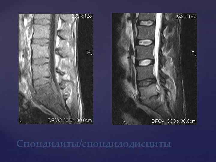 Спондилиты/спондилодисциты 