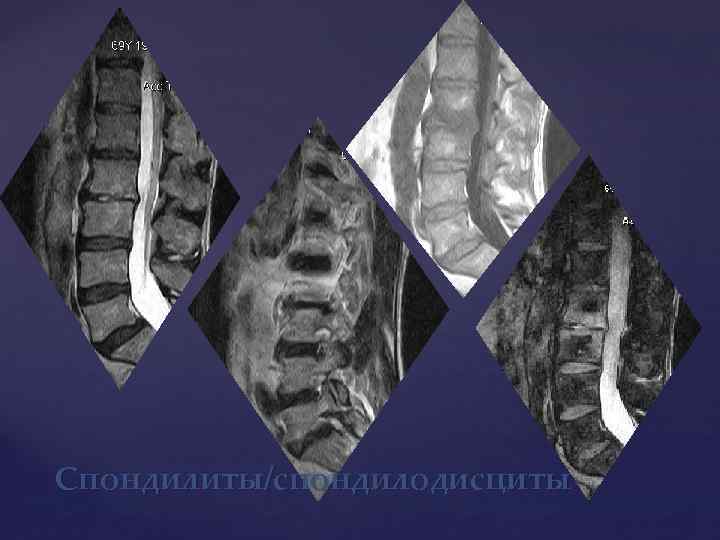 Спондилиты/спондилодисциты 