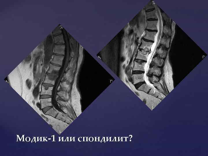 Модик-1 или спондилит? 