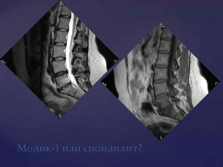 Модик-1 или спондилит? 