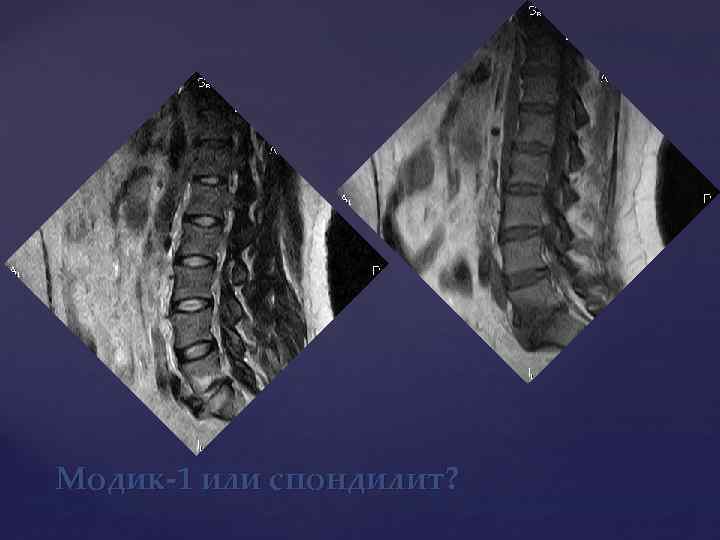 Модик-1 или спондилит? 