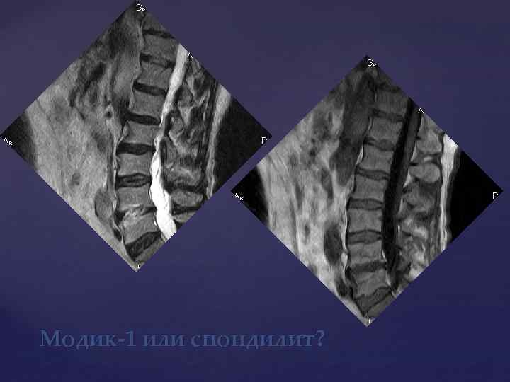 Модик-1 или спондилит? 