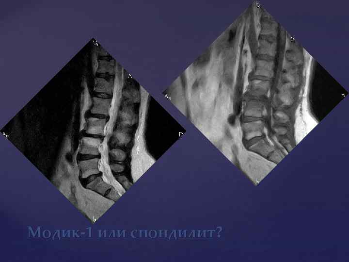 Модик-1 или спондилит? 