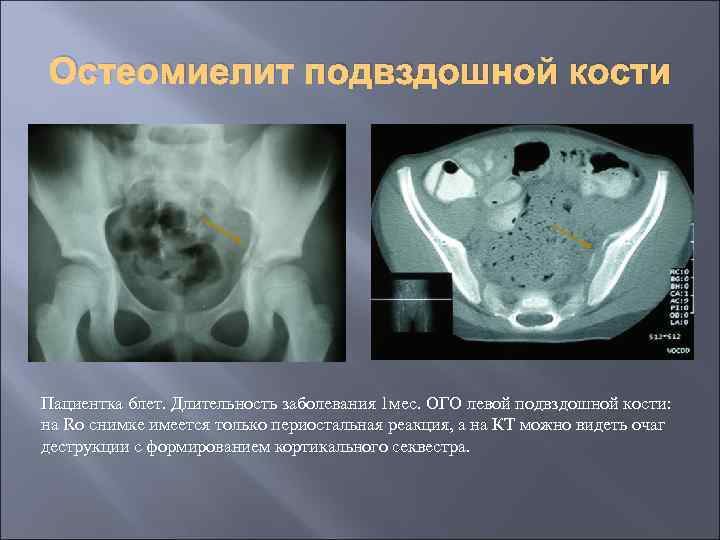 Остеомиелит подвздошной кости Пациентка 6 лет. Длительность заболевания 1 мес. ОГО левой подвздошной кости:
