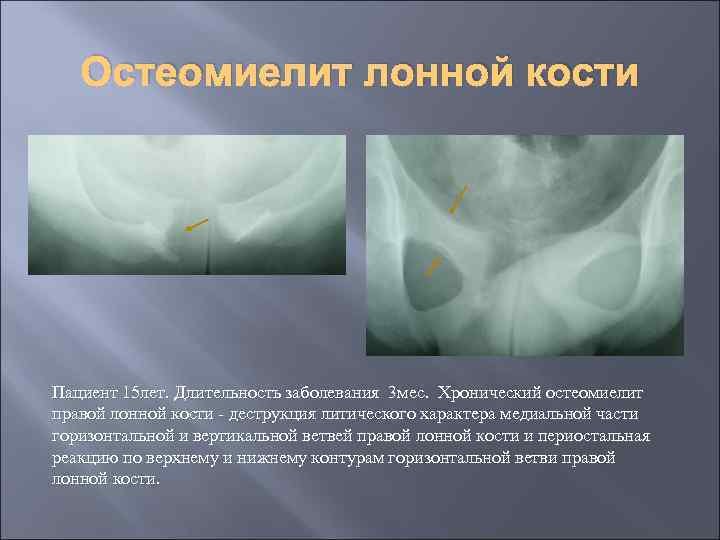 Остеомиелит лонной кости Пациент 15 лет. Длительность заболевания 3 мес. Хронический остеомиелит правой лонной