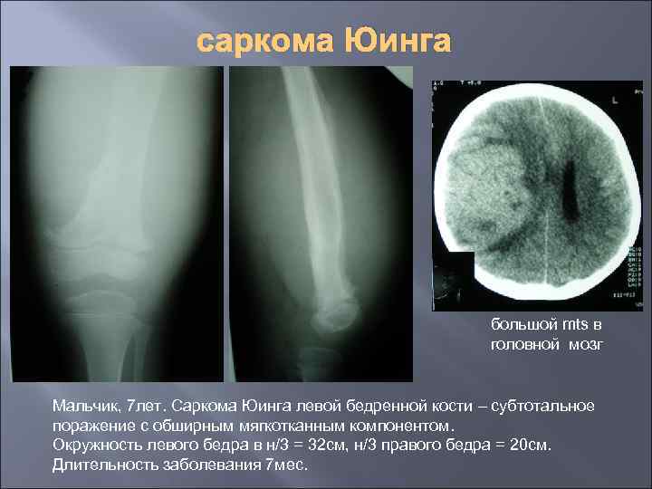 саркома Юинга большой mts в головной мозг Мальчик, 7 лет. Саркома Юинга левой бедренной