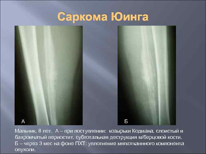 Саркома Юинга А Б Мальчик, 8 лет. А – при поступлении: козырьки Кодмана, слоистый