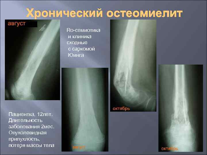 Хронический остеомиелит Ro-семиотика и клиника сходные с саркомой Юинга Пациентка, 12 лет. Длительность заболевания