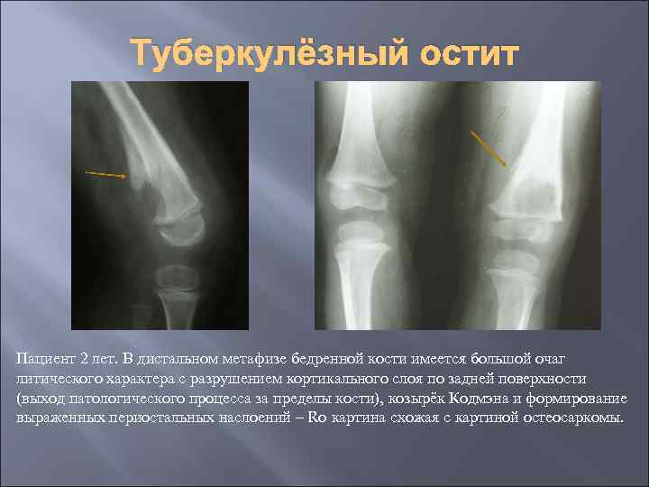 Туберкулёзный остит Пациент 2 лет. В дистальном метафизе бедренной кости имеется большой очаг литического