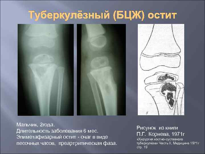 Туберкулёзный (БЦЖ) остит Мальчик, 2 года. Длительность заболевания 6 мес. Эпиметафизарный остит - очаг