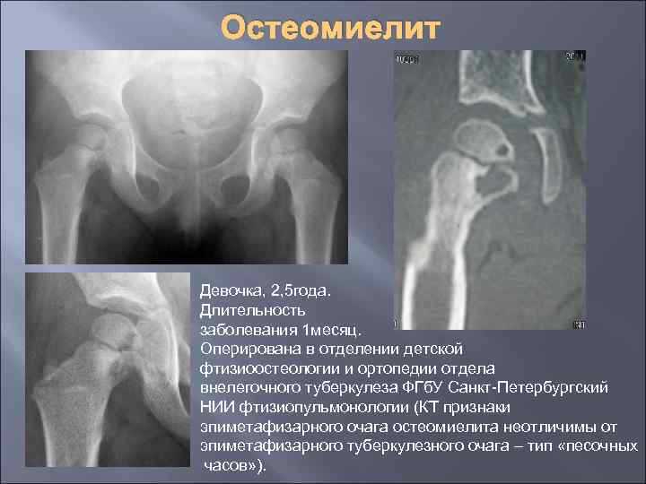 Остеомиелит Девочка, 2, 5 года. Длительность заболевания 1 месяц. Оперирована в отделении детской фтизиоостеологии