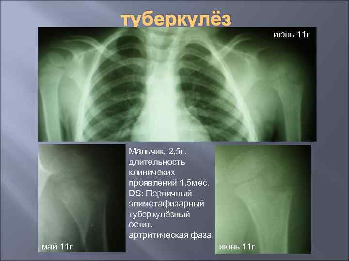 туберкулёз июнь 11 г Мальчик, 2, 5 г. длительность клиничеких проявлений 1, 5 мес.
