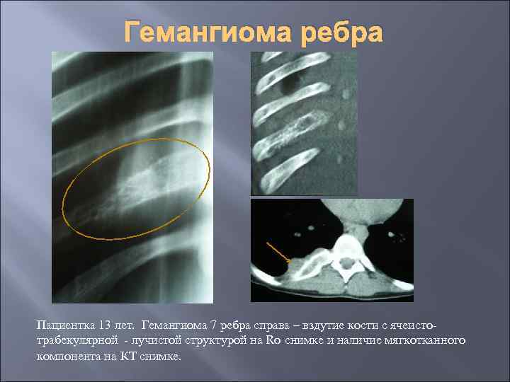 Гемангиома ребра Пациентка 13 лет. Гемангиома 7 ребра справа – вздутие кости с ячеистотрабекулярной