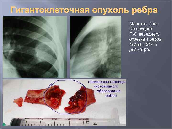 Гигантоклеточная опухоль ребра Мальчик, 7 лет Ro находка ГКО переднего отрезка 4 ребра слева