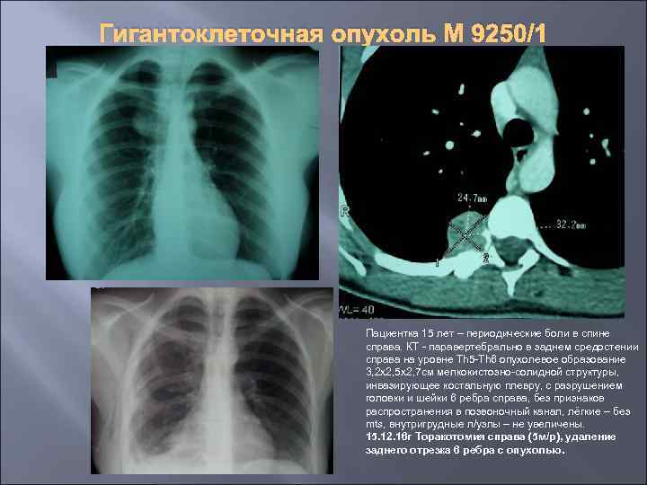 Гигантоклеточная опухоль М 9250/1 Пациентка 15 лет – периодические боли в спине справа. КТ