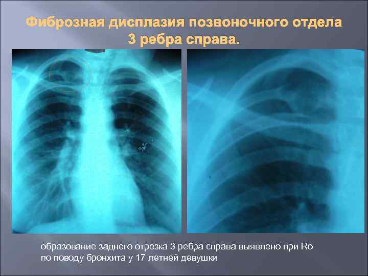 Фиброзная дисплазия позвоночного отдела 3 ребра справа. образование заднего отрезка 3 ребра справа выявлено