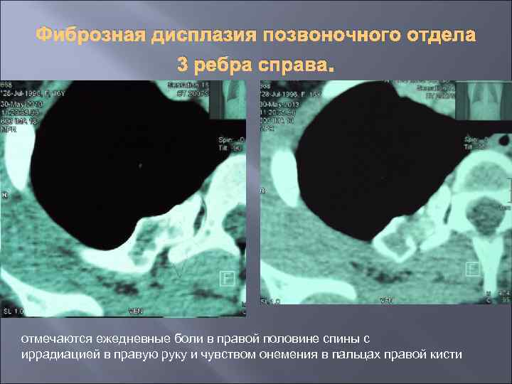 Фиброзная дисплазия позвоночного отдела 3 ребра справа. отмечаются ежедневные боли в правой половине спины