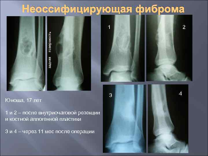 Неоссифицирующая фиброма 1 Юноша, 17 лет 1 и 2 – после внутриочаговой резекции и