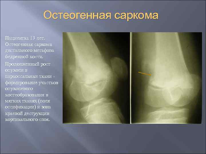 Остеогенная саркома Пациентка 13 лет. Остеогенная саркома дистального метафиза бедренной кости. Продолженный рост опухоли