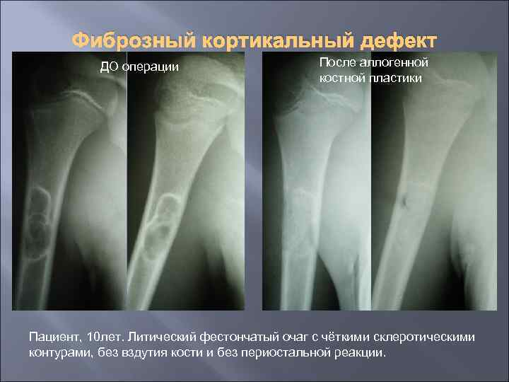 Фиброзный кортикальный дефект ДО операции После аллогенной костной пластики Пациент, 10 лет. Литический фестончатый