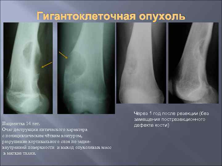 Гигантоклеточная опухоль Пациентка 14 лет. Очаг деструкции литического характера с полициклическим чётким контуром, разрушение