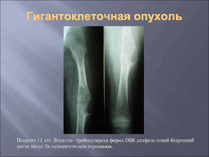 Гигантоклеточная опухоль Пациент 12 лет. Ячеисто– трабекулярная форма ОБК диафиза левой бедренной кости после
