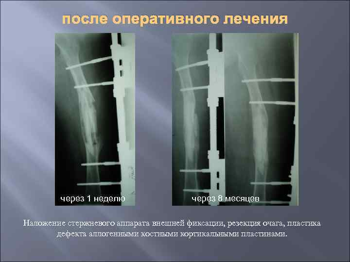 после оперативного лечения через 1 неделю через 8 месяцев Наложение стержневого аппарата внешней фиксации,