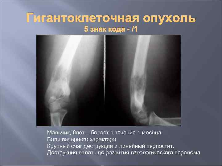 Гигантоклеточная опухоль 5 знак кода - /1 Мальчик, 8 лет – болеет в течение