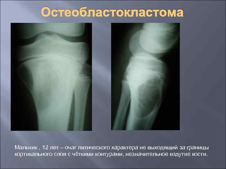 Остеобластокластома Мальчик , 12 лет – очаг литического характера не выходящий за границы кортикального